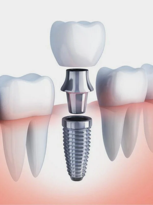 Dental Implants — Forest Hill Dental | Memphis, TN